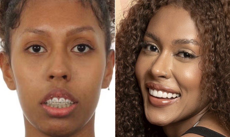 Giovanna Jacobina, antes e depois: ex-BBB fez cirurgia ortognática para mudar a aparência do rosto