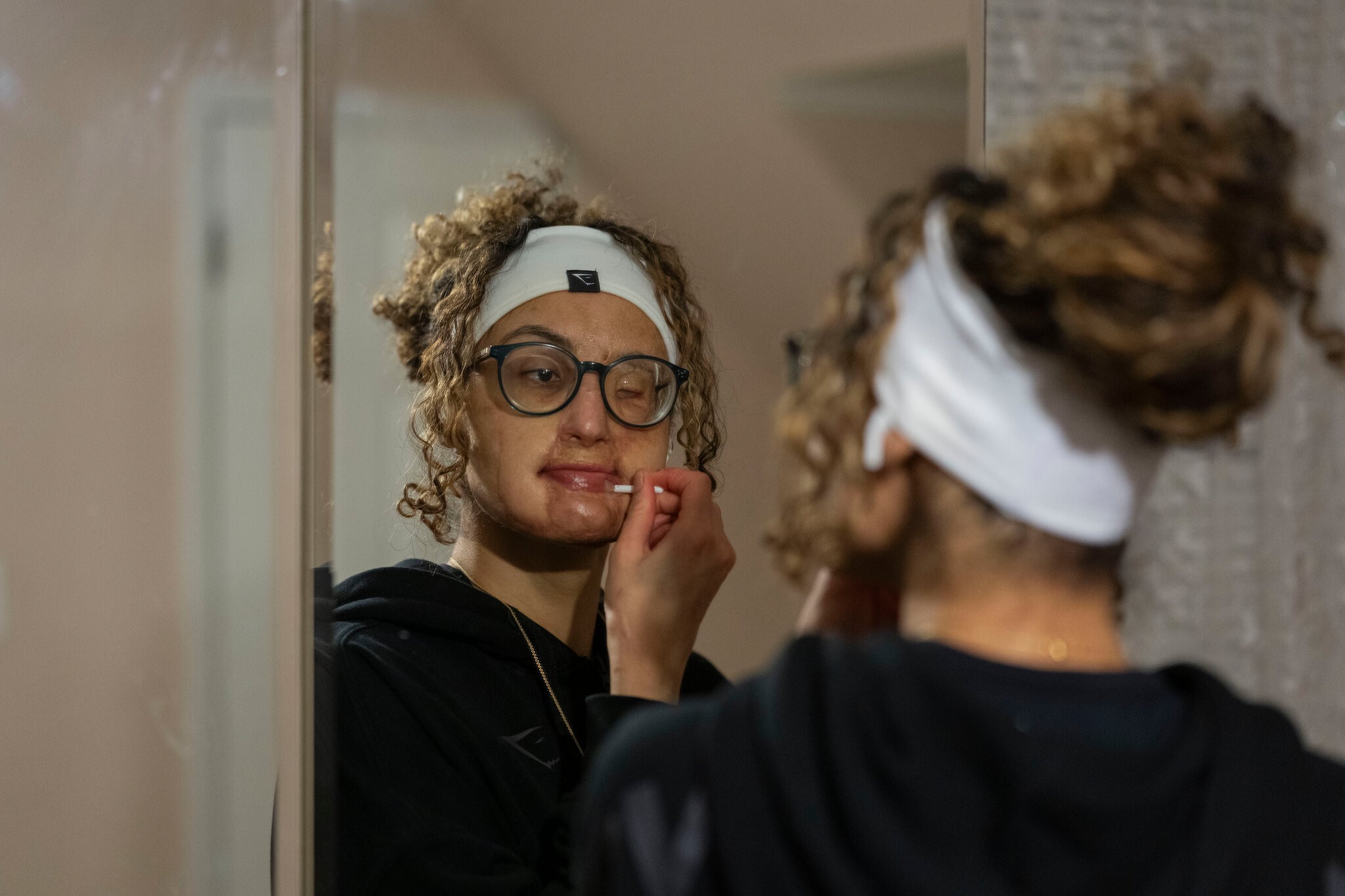 Sobrevivente de ataque com ácido busca reconstruir vida e autoestima