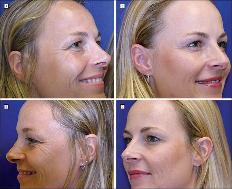 À esquerda, gêmea que realizou duas sessões de Botox em 13 anos. À direita, gêmea que realizou o procedimento anualmente. — Foto: Archives of Facial Plastic Surgery