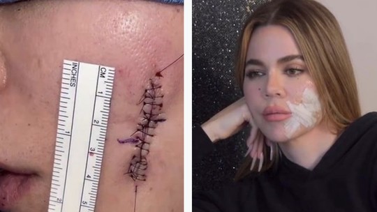 Khloe Kardashian mostra cicatriz no rosto após retirar melanoma em cirurgia e fãs elogiam: 'Corajoso'