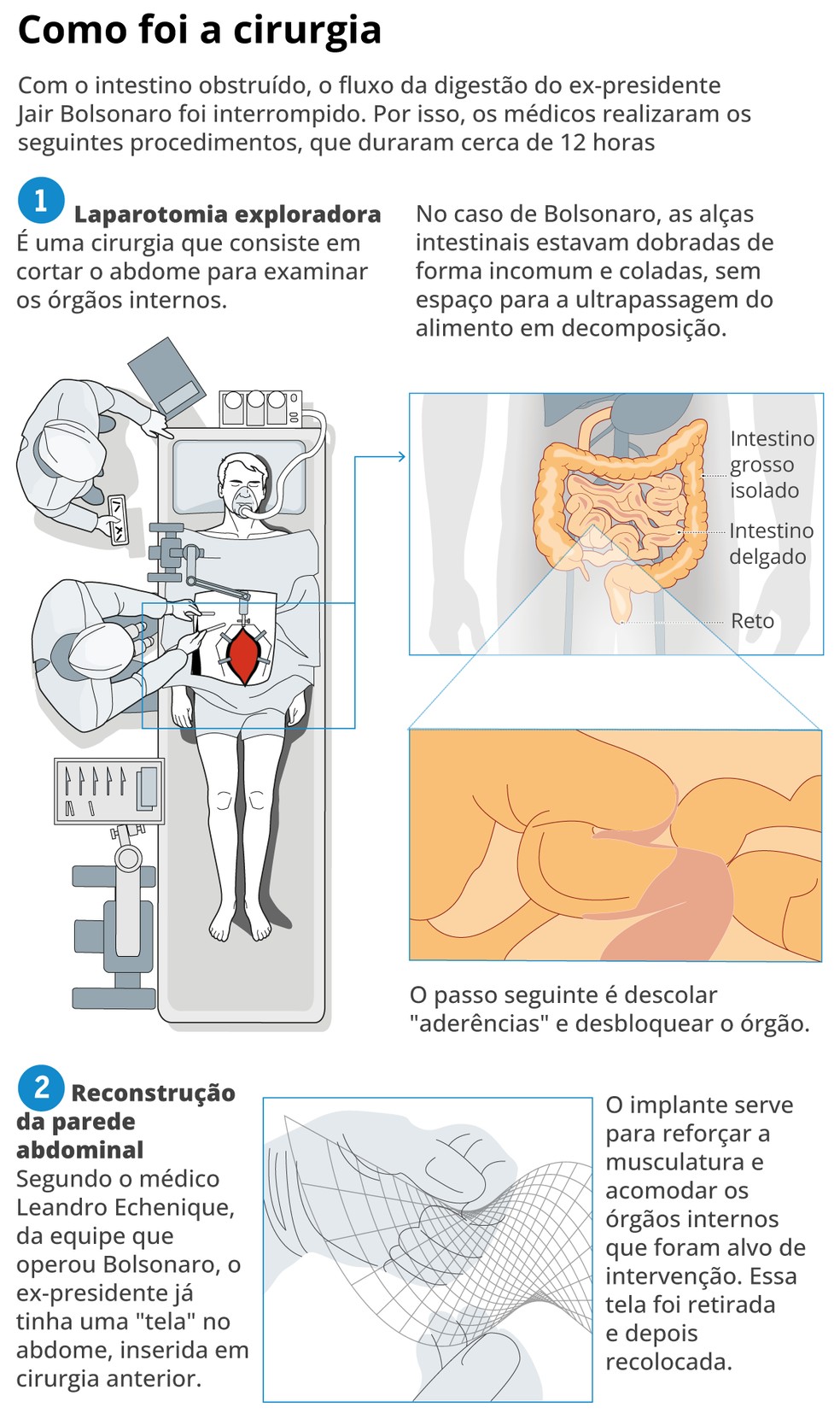 Entenda a cirurgia de Bolsonaro — Foto: Editoria de Arte