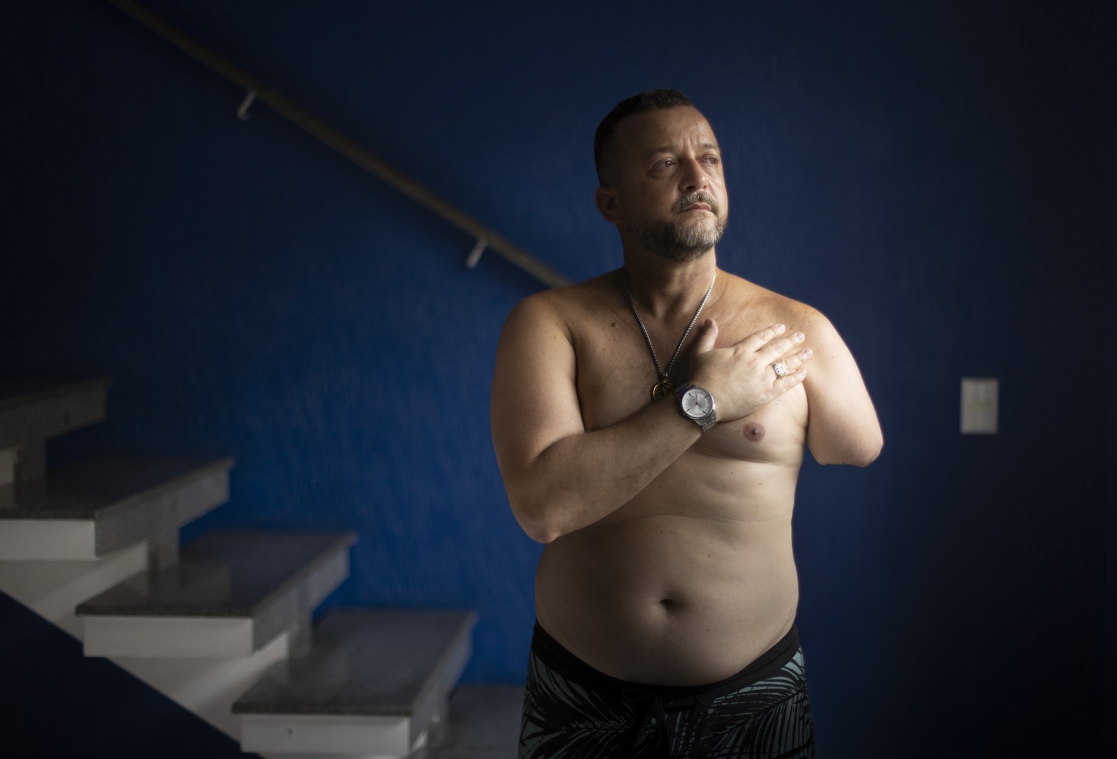 Alessandro Silva Ribeiro teve o braço amputado após ser atingido por um tiro de fuzil disparado por um policial militar na Penha — Foto: Márcia Foletto
