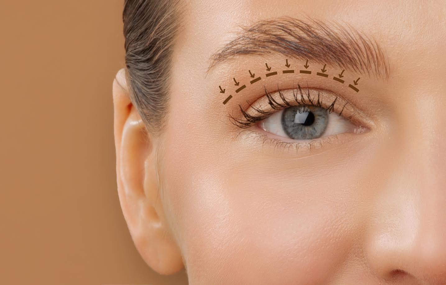 Blefaroplastia envolve função ocular além da estética