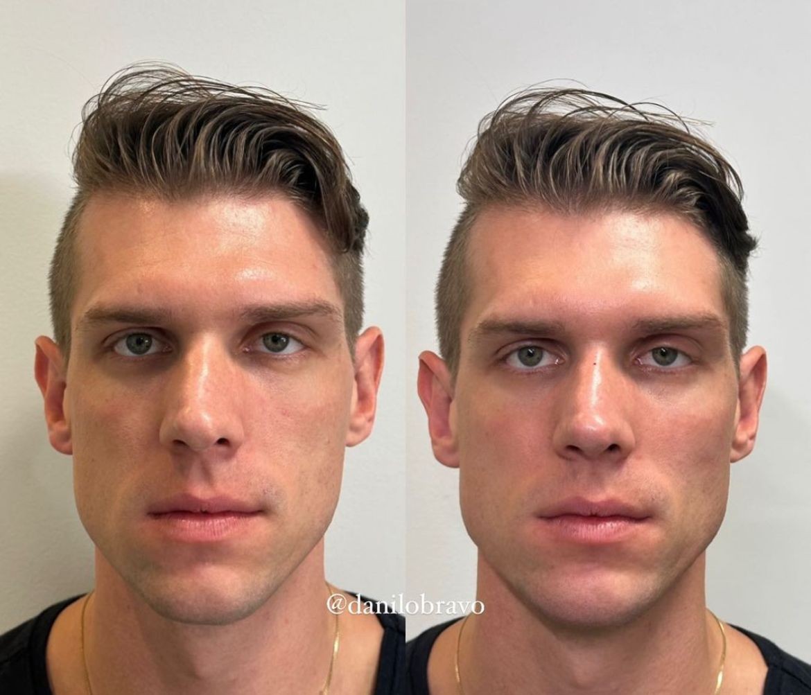 Cristian também fez harmonização facial logo após deixar a casa — Foto: Reprodução/Instagram