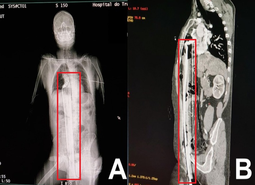 Imagens da barra de ferro atravessando o corpo do homem