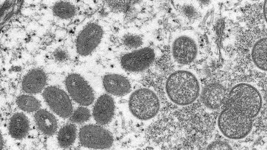 Varíola do macaco: Europa tem três casos confirmados dessa doença rara; entenda