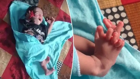 Deusa hindu? Criança nasce com 26 dedos na Índia; veja