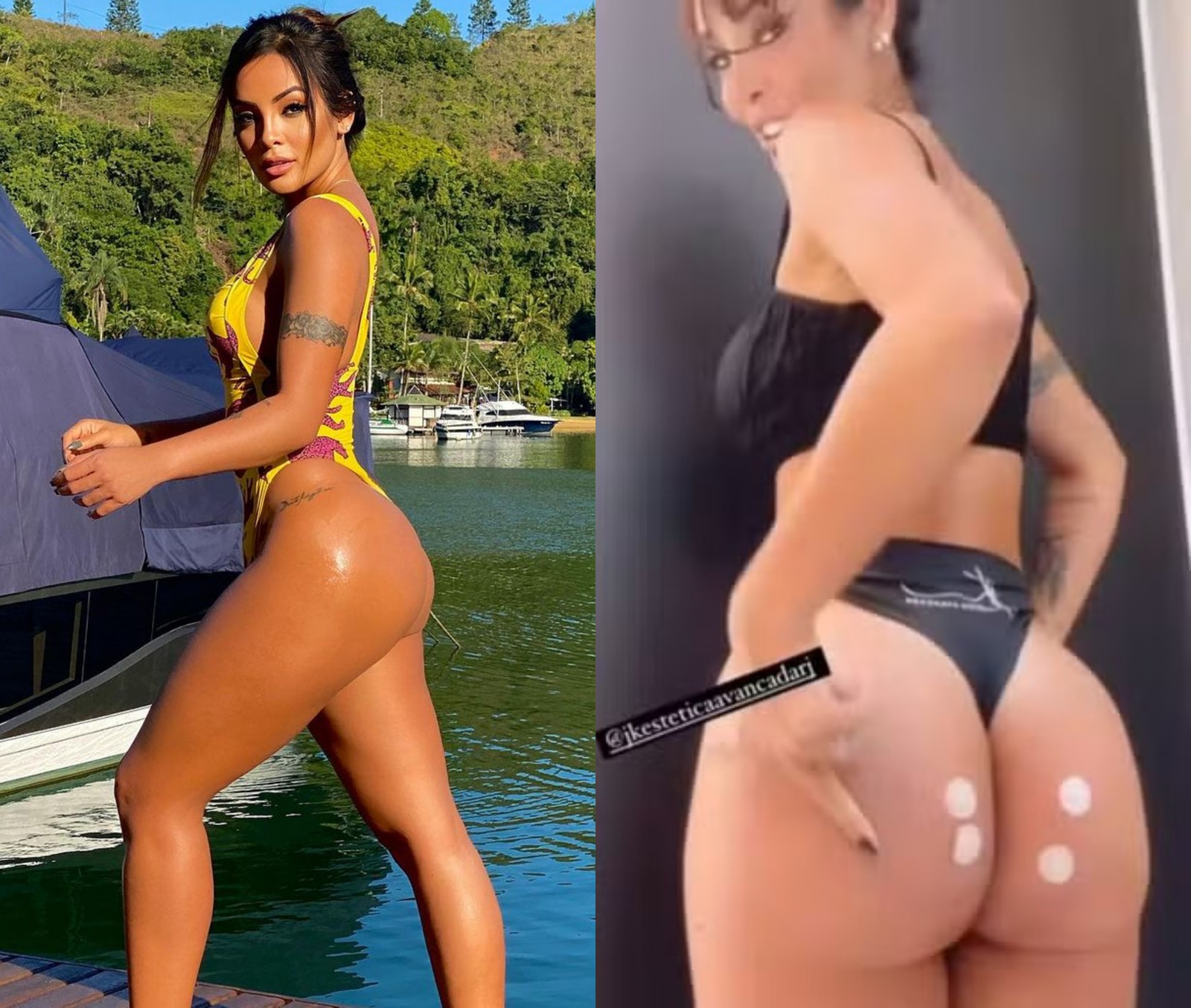 Bumbum: Carol Nakamura fez Prosidemento comAminoácidos IndetáveisEaplicação deácido Hialurônico-foto: reprodução Instagram