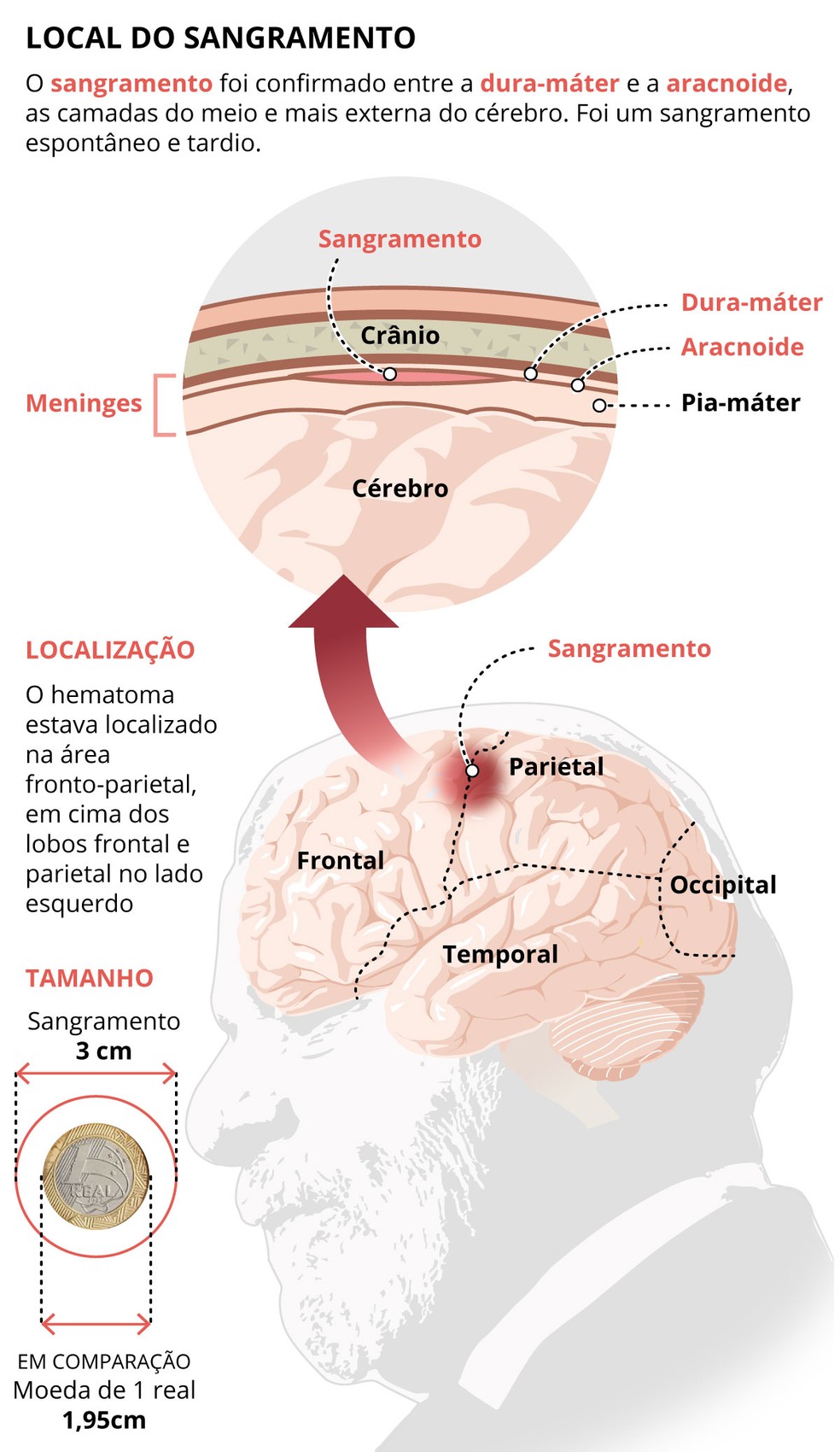 Localização do sangramento do Presidente Lula — Foto: Arte O Globo