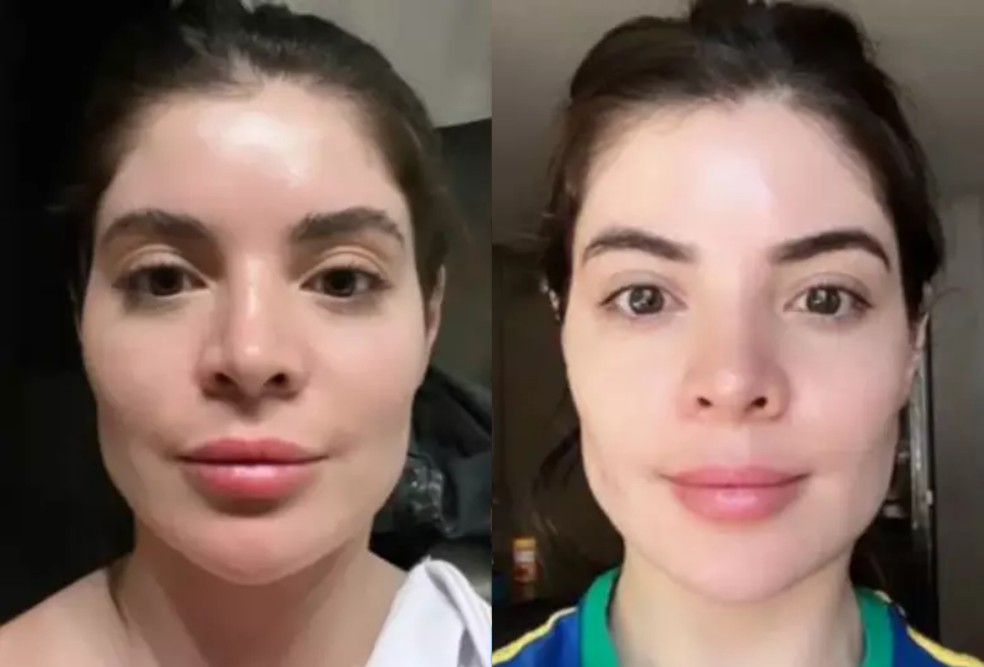 Gkay desfez harmonização facial — Foto: Reprodução Instagram