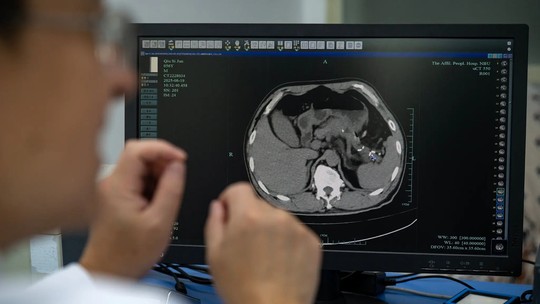 Na China, a IA está encontrando tumores mortais que médicos podem não perceber; entenda