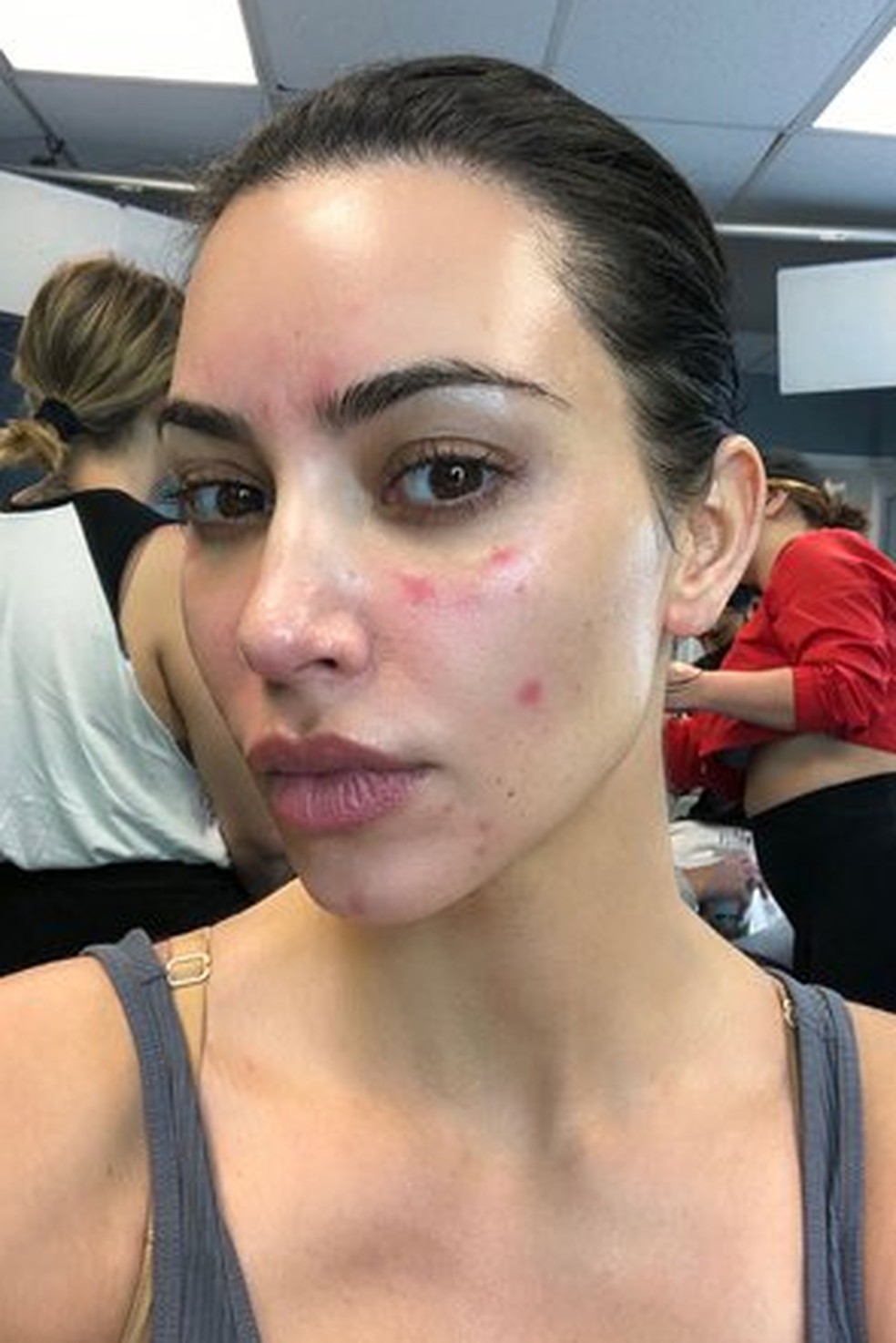 Kim Kardashian tornou público o diagnóstico de psoríase em 2018 — Foto: Reprodução/Instagram