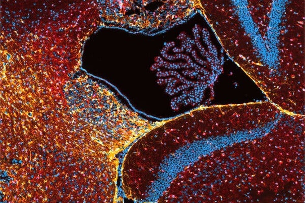 Cientistas que estudam maneiras de controlar a propagação do câncer no cérebro capturaram essa imagem depois de modificar células de câncer de mama e implantá-las no cérebro de um rato — Foto: Sonu Subudhi e Sophie Steinbuch, Hospital Geral de Massachusetts