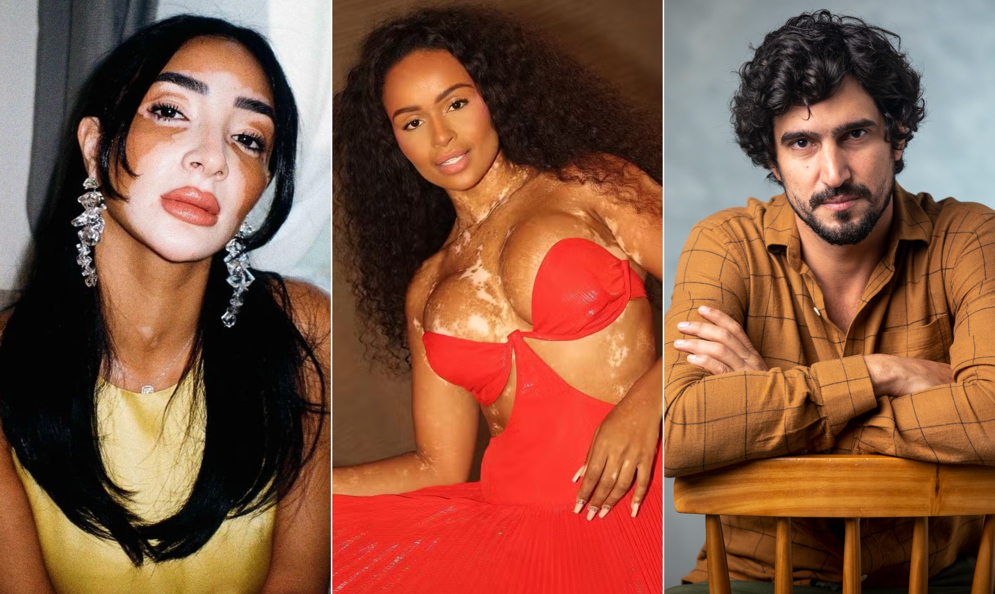 Vitiligo: além da candidata do Miss Universo, conheça 3 famosos que convivem com a condição