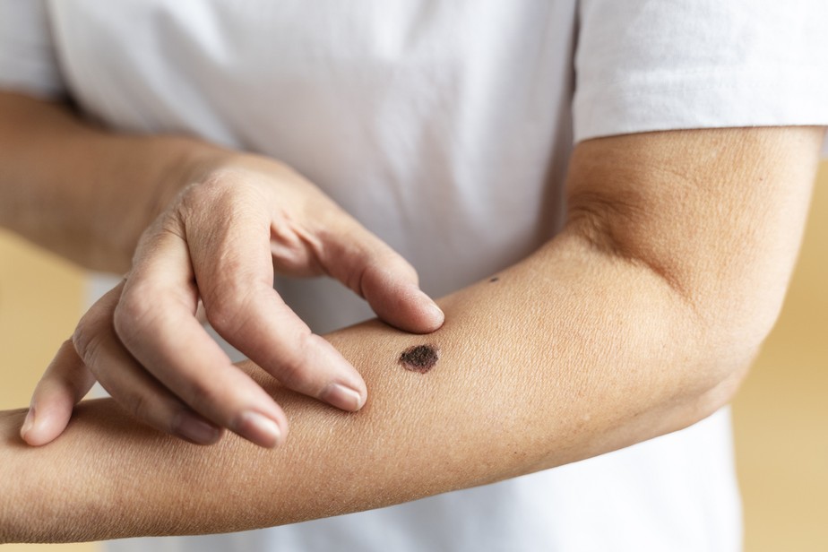 Sinal revelador de câncer pode ser notado na ponta dos dedos