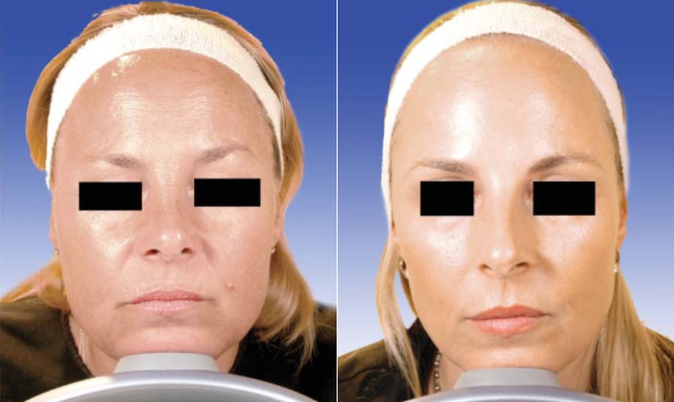 À esquerda, gêmea que realizou duas sessões de Botox em 13 anos. À direita, gêmea que realizou o procedimento anualmente. — Foto: Dermatologic Surgery