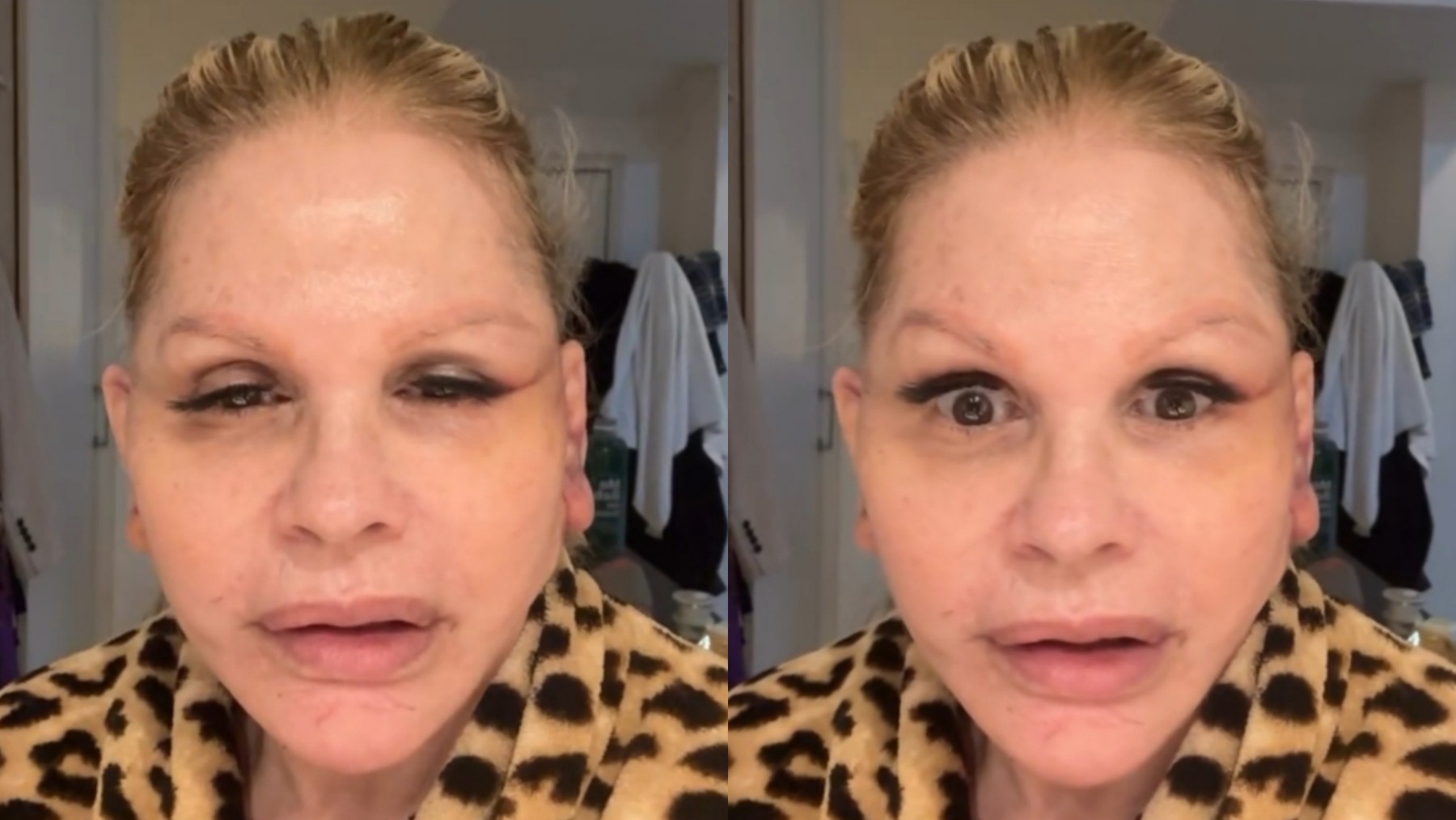 O que acontece com o rosto após uma cirurgia facial? Caso de Monique Evans ajuda a explicar o processo - QTU Questões do Universo