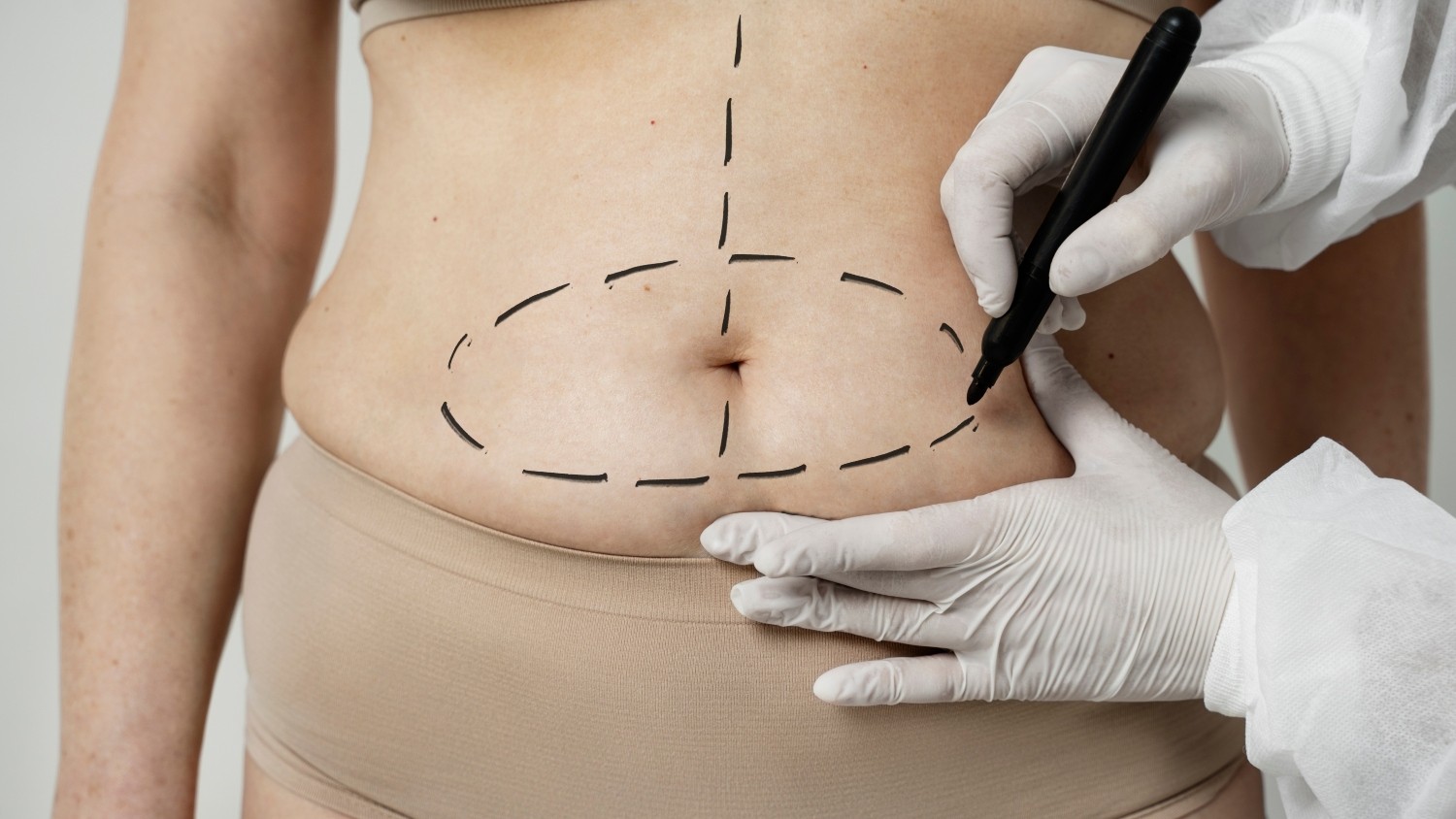 Cirurgias reparadoras pós-bariátrica: entenda como funcionam e quando são indicadas
