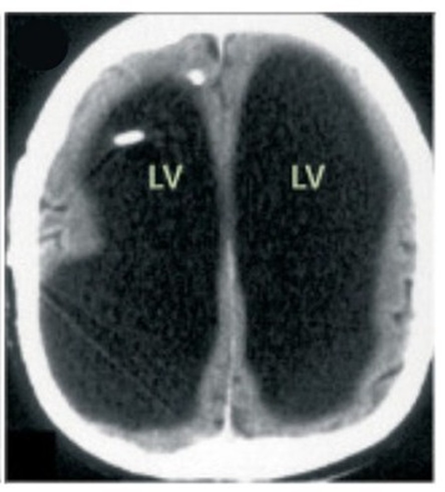 Caso de homem de 44 anos que descobriu ter s&oacute; a metade do c&eacute;rebro ap&oacute;s  sintoma comum nas pernas volta &agrave;s redes; relembre o caso
