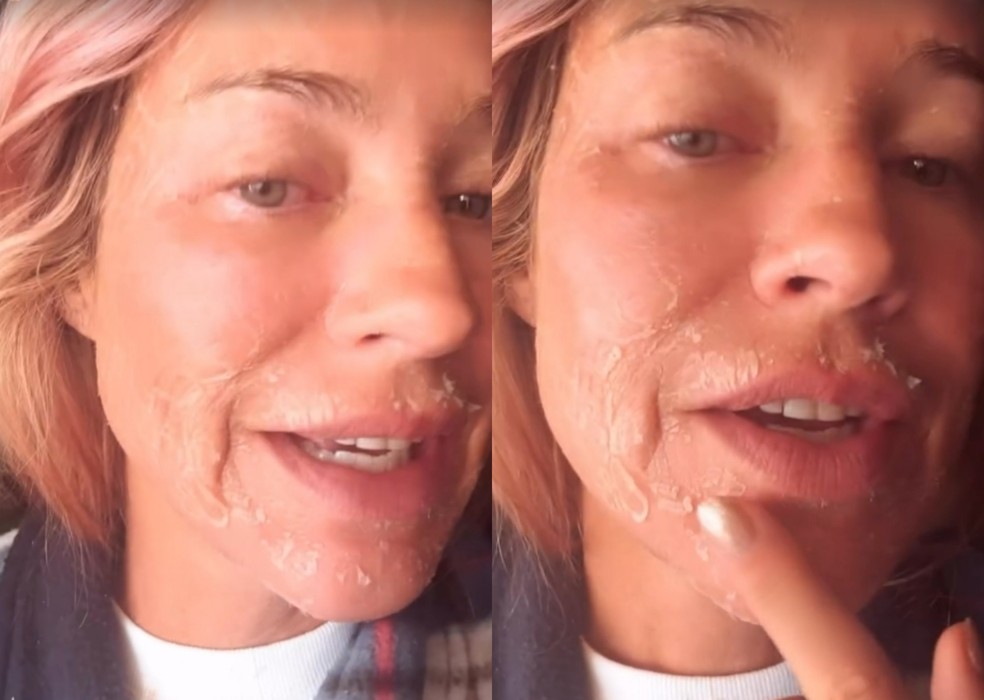 Luana Piovani surge com rosto descamando e chama atenção nas redes — Foto: Reprodução Instagram