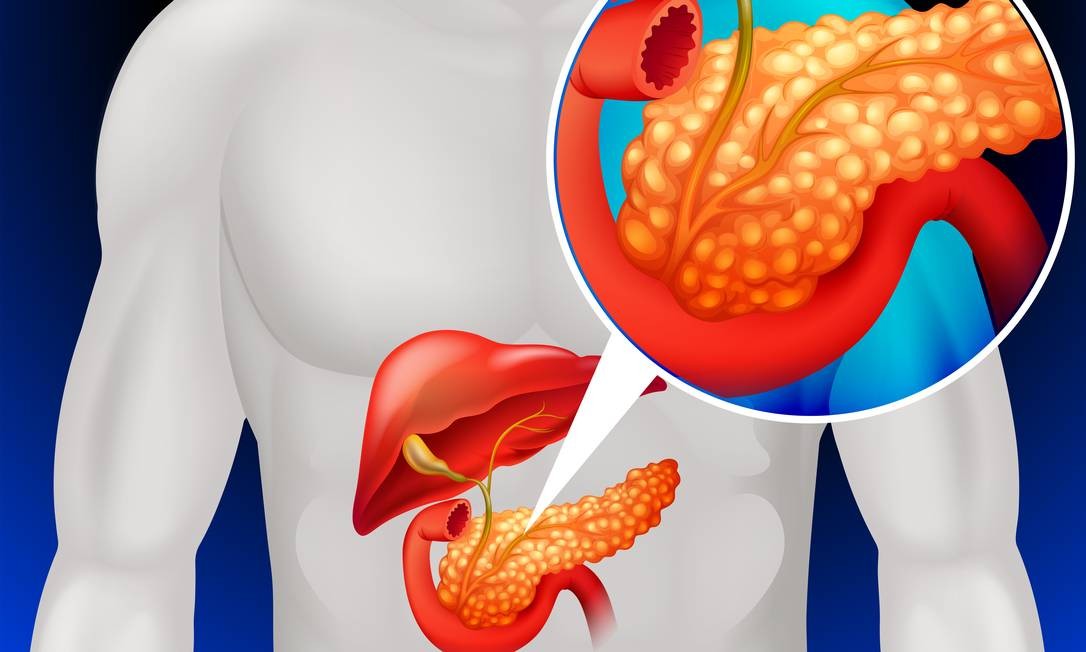 Paciente com câncer de pâncreas morre após diagnóstico apontar diabetes; órgão aponta falhas médicas - QTU Questões do Universo