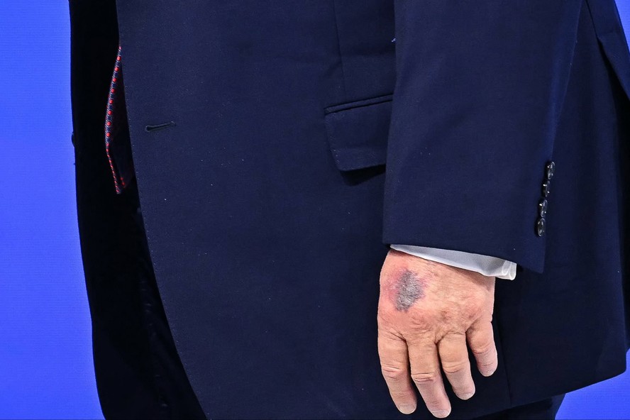 Hematoma na mão de Trump volta a chamar atenção em Davos; Casa Branca ...