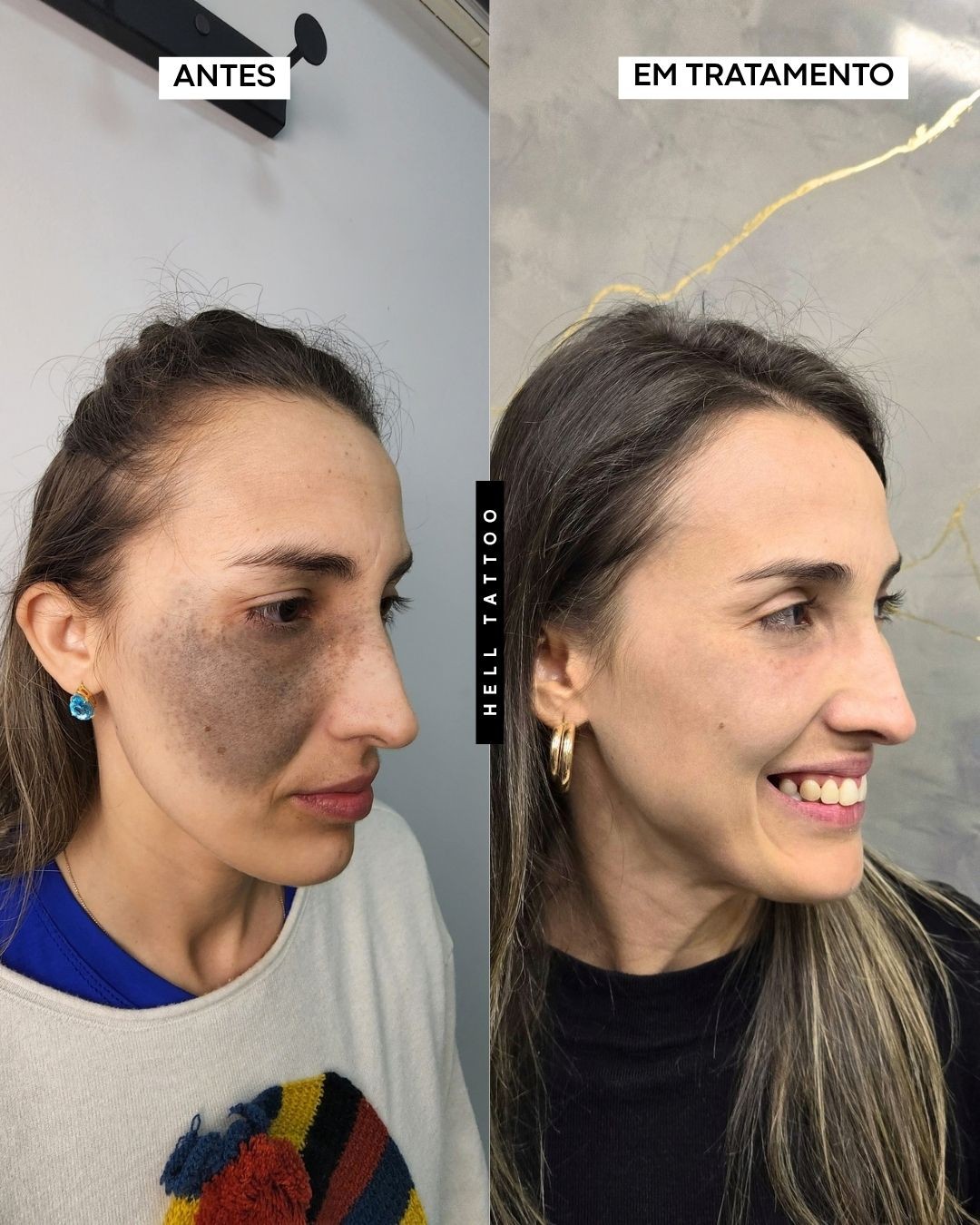 Nevo de Ota pode ser tratado com laser, explica biomédico