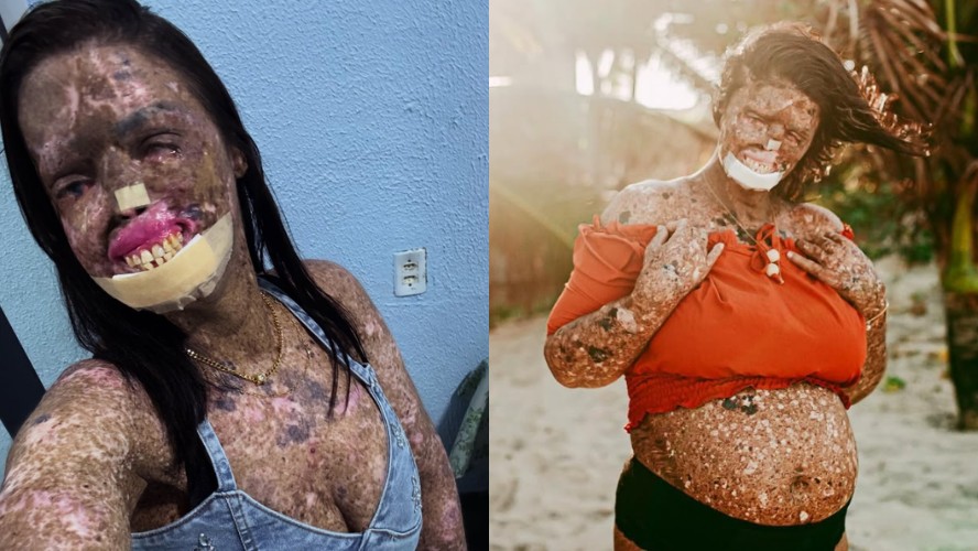 Káh Felipe, Influencer Cearense, Morre Após Luta Contra Xeroderma Pigmentoso e Câncer Terminal