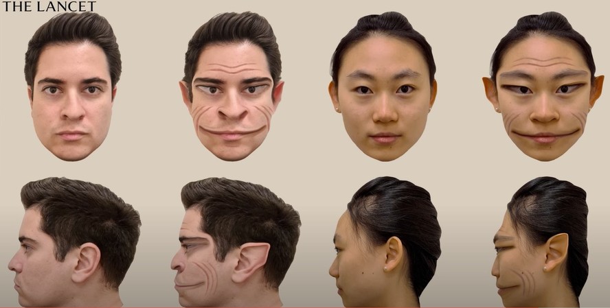 Exemplo de como uma pessoa com prosopometamorfopsia (PMO, na sigla em inglês) vê outras faces