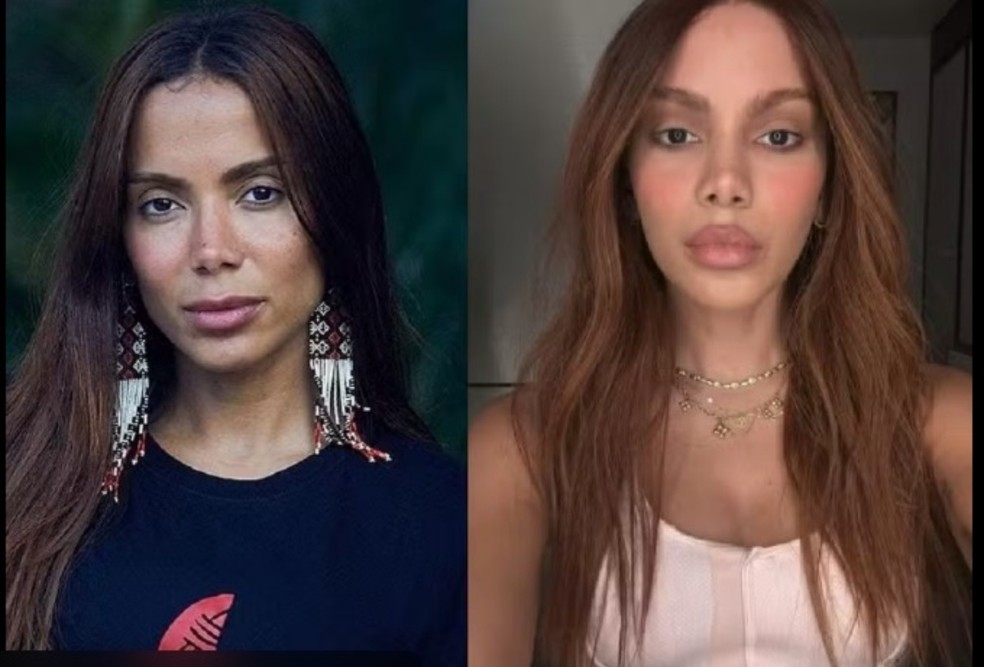 Before and after the procedures performed by Anitta — Photo: Instagram reproduction