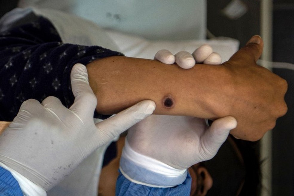 Paciente com monkeypox é examinado no hospital Arzobispo Loayza em Lima, no Peru — Foto: Ernesto BENAVIDES / AFP