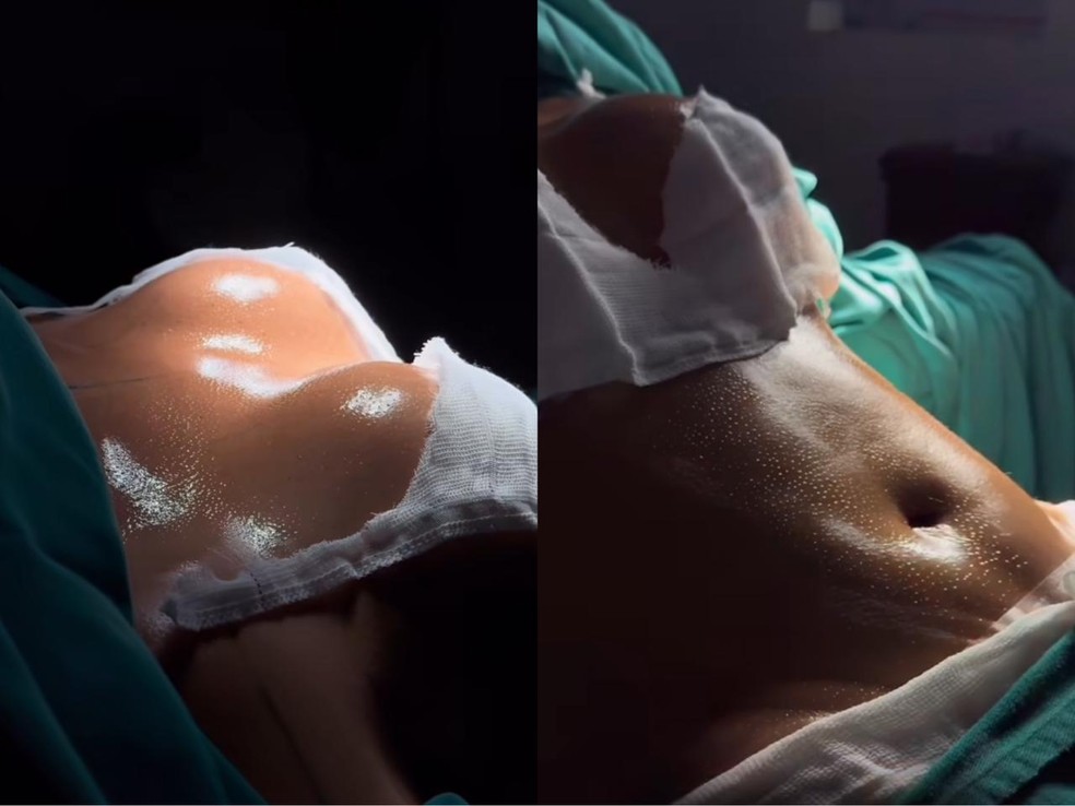 Mani Rego mostra o pós imediato das cirurgias plásticas — Foto: Reprodução/Instagram