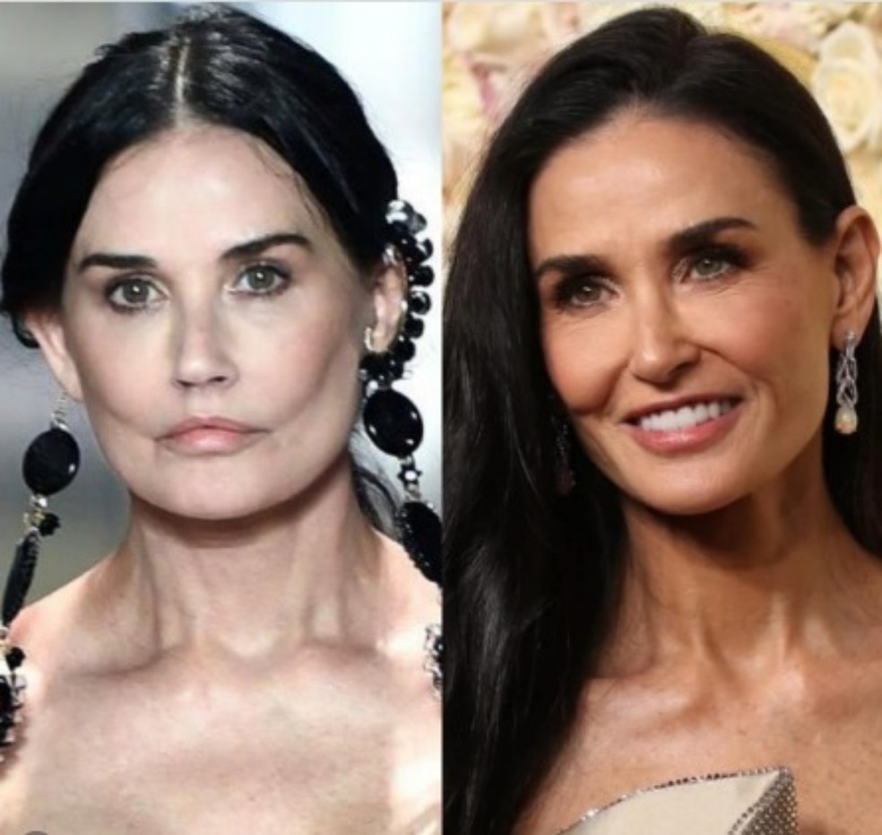 Before and after procedures performed by Demi Moore — Photo: Getty Images
