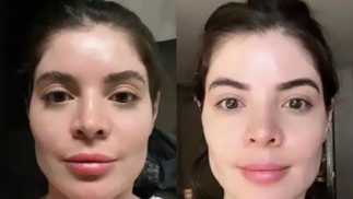 Gkay desfez harmonização facial — Foto: Reprodução Instagram