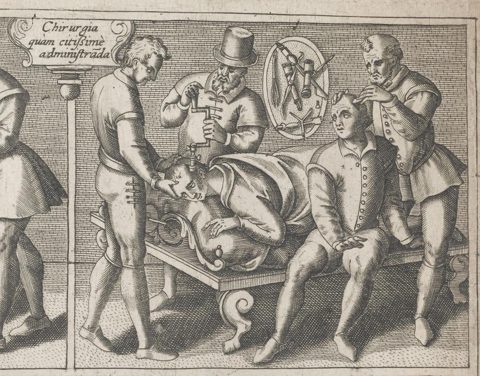 O que é trepanação? Procedimento realizado em Lula é utilizado há quase 10 mil anos