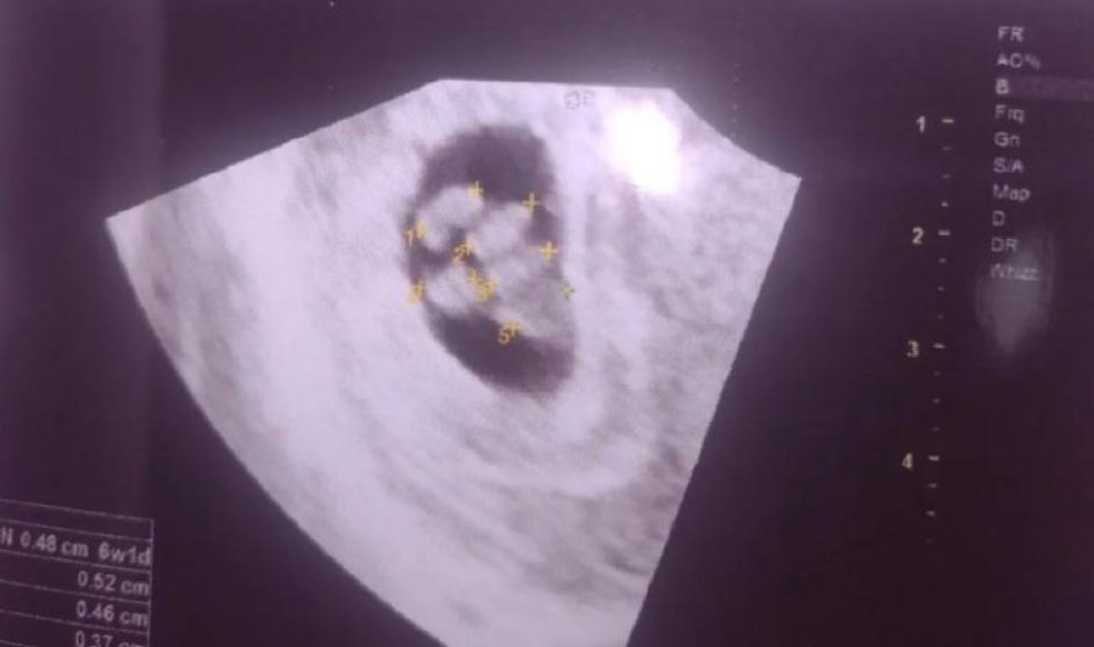 Imagem do ultrassom da Sara Silva, de 18 anos — Foto: Reprodução