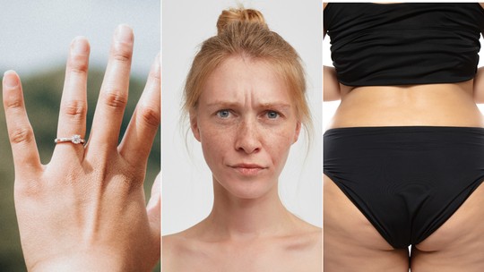 Anatomia Ozempic: dedo, rosto e bumbum: os efeitos não desejados do emagrecimento com o remédio da moda