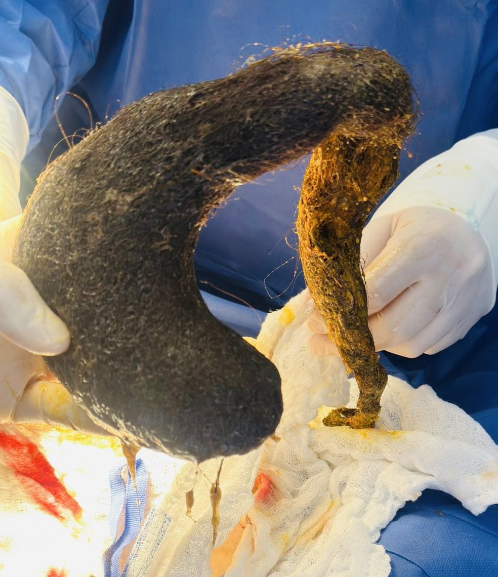 Bola de pelo retirada do estômago da mulher — Foto: Reprodução/Hospital Verdi