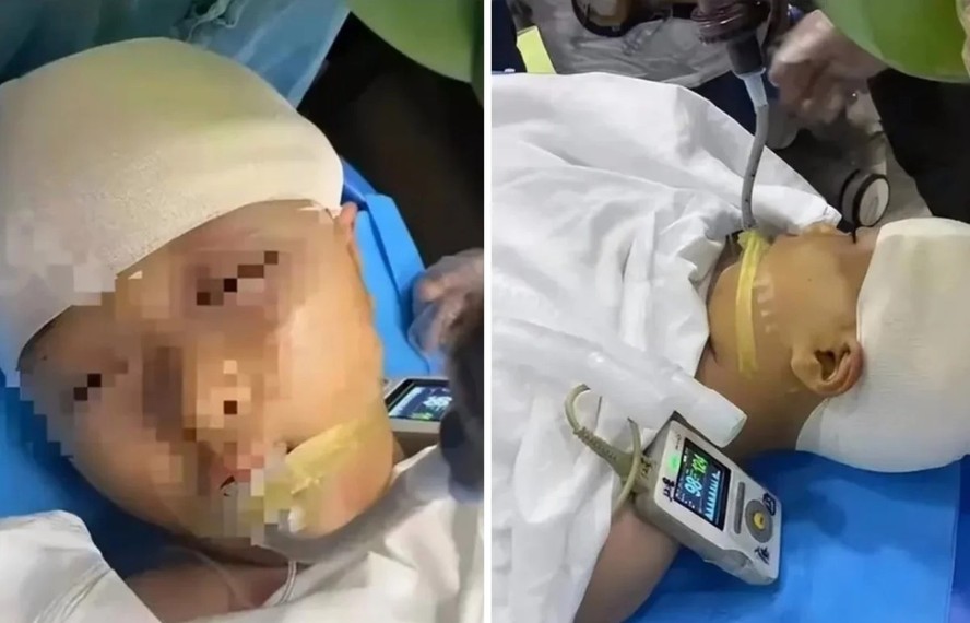 Menina de 9 anos tem traumatismo craniano após ser agredida com régua por professor na China