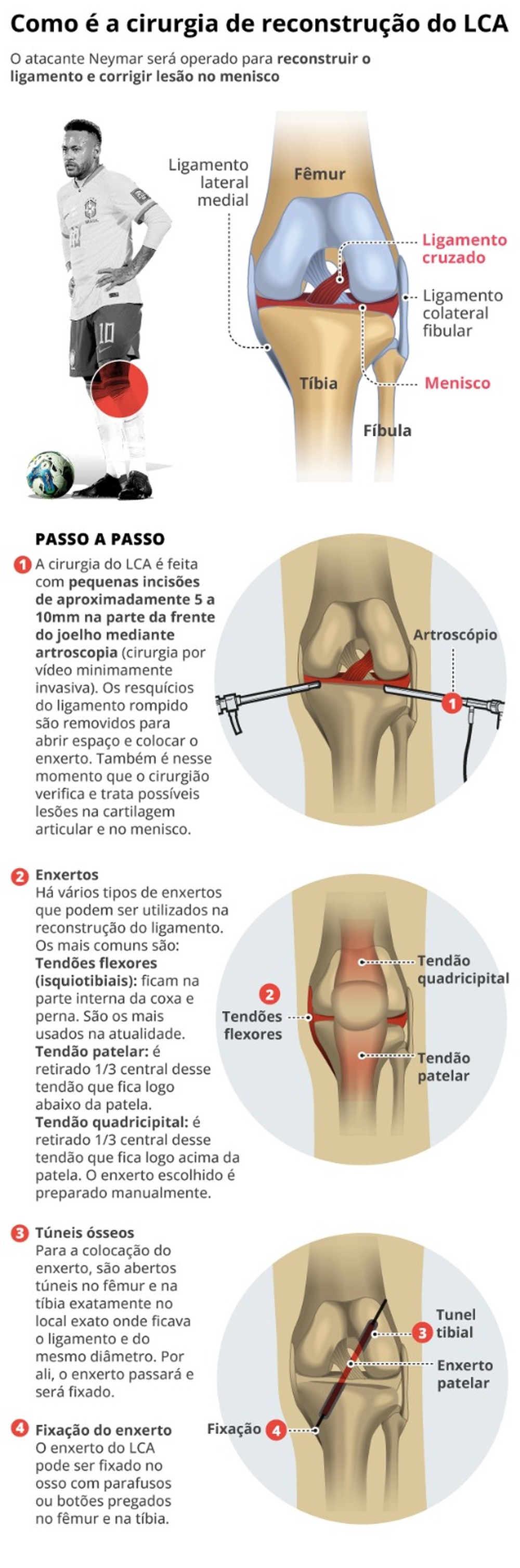 O Que E Lca Cirurgia