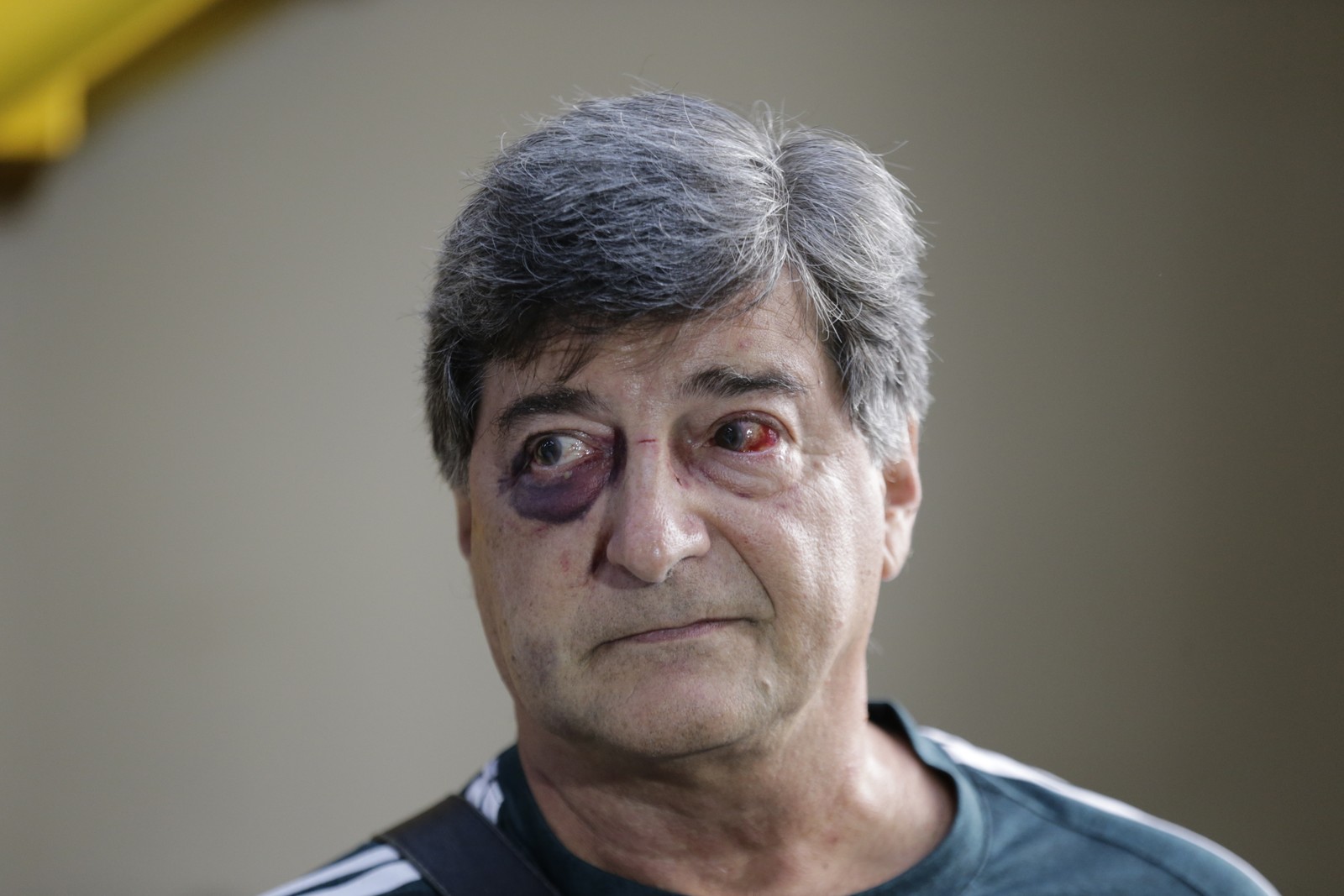 Na época, Marcelo Benchimol ficou com as marcas da agressão no rosto — Foto: Domingos Peixoto / Arquivo