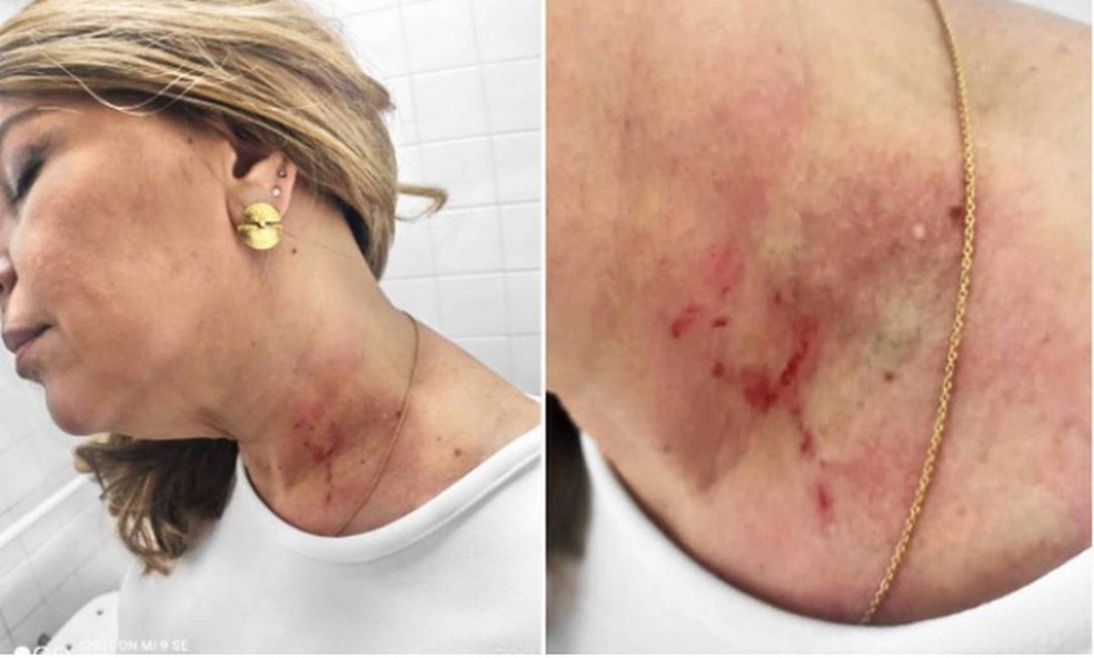 A vereadora Cris Monteiro mostra os machucados que teria sofrido durante agressão da vereadora Janaína Lima, que diz que foi agredida primeiro — Foto: Reprodução
