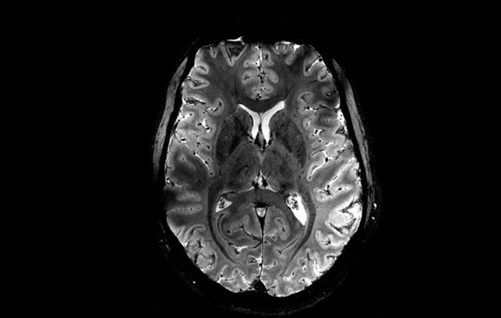 Imagem do Iseult Magneton 11.7 T MRI mostra cérebro humano. — Foto: Divulgação / Comissão de Energia Atômica da França (CEA)