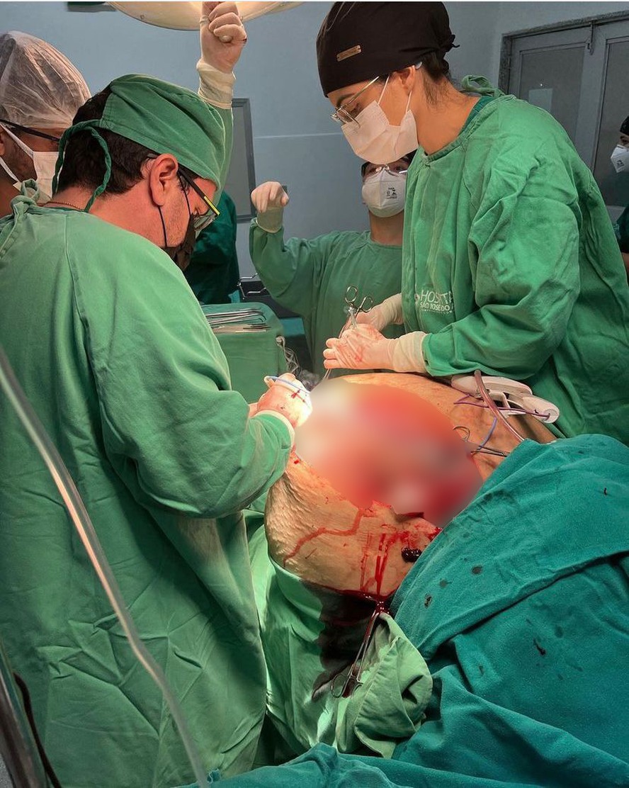 Paciente passa por cirurgia para retirada de tumor de 46 kg