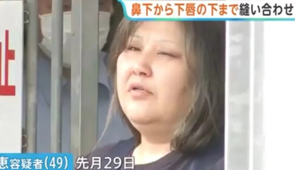 Japão: Mulher é Presa por Costurar Lábios da Colega de Quarto