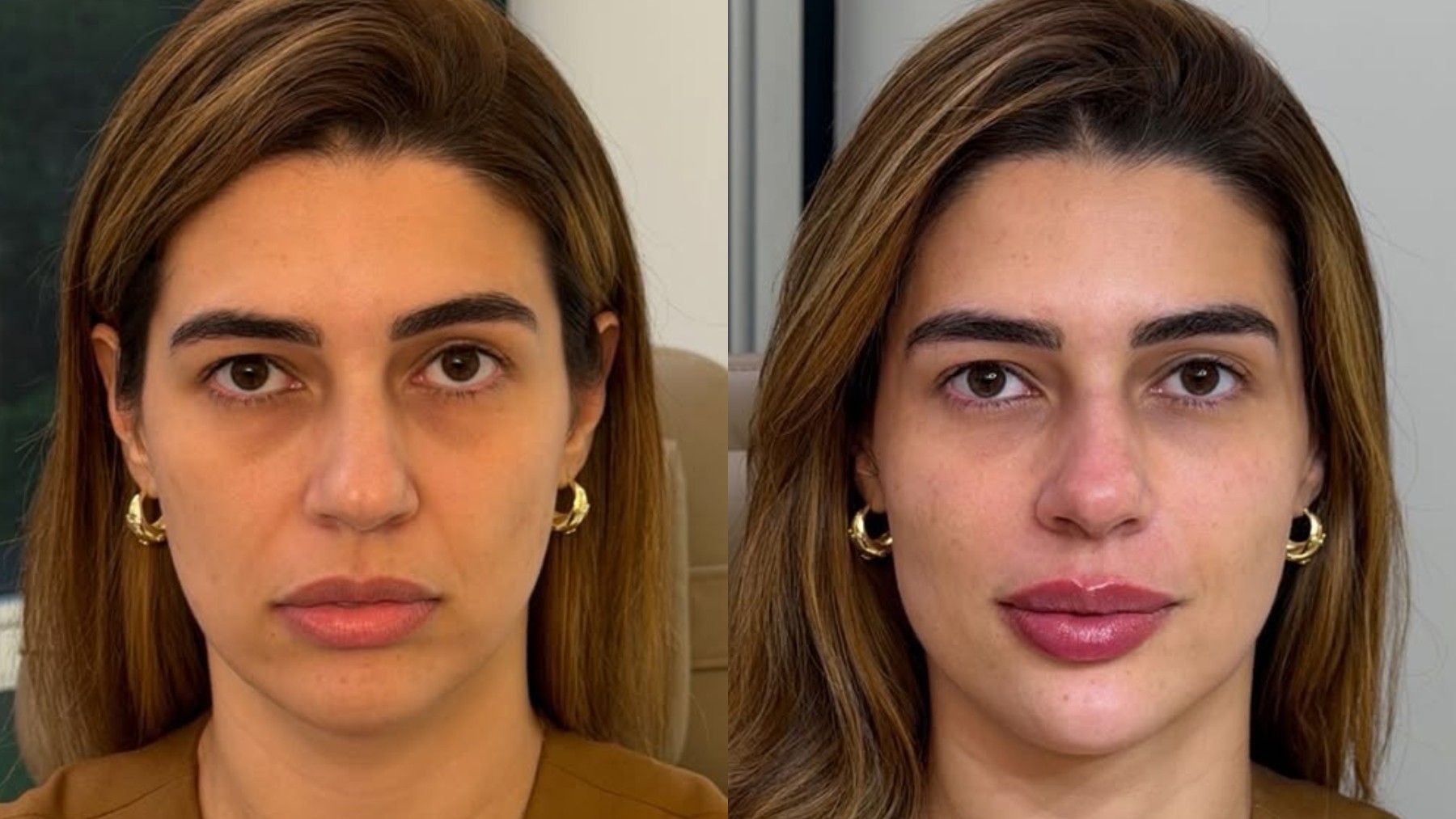 O motivo por trás do procedimento facial de Vivian Amorim após perda de peso