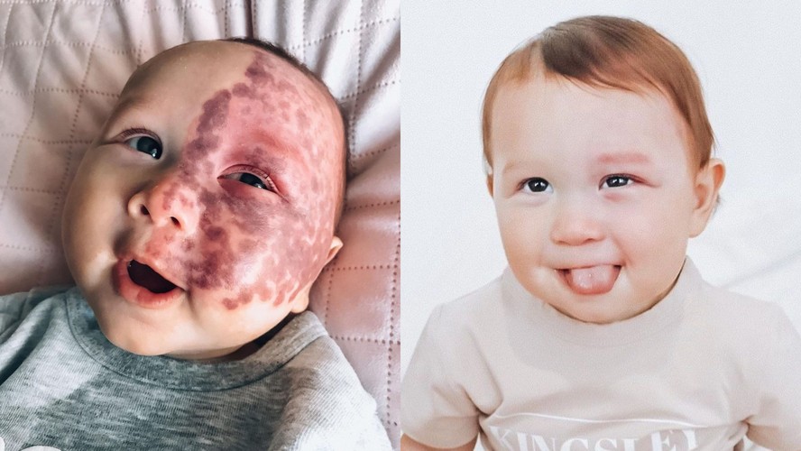 Bebê que fez tratamento a laser aos 5 meses na Austrália não tem mais sinais no rosto