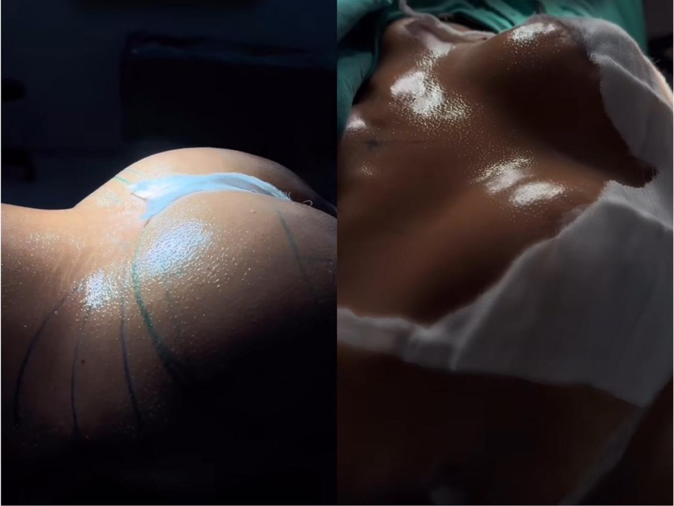 Mani Rego fez lipo e colocou silicone — Foto: Reprodução/Instagram