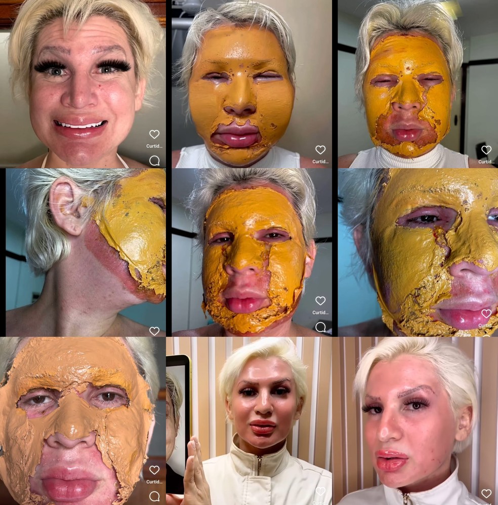Influenciadora Romagaga mostra rosto antes e depois do peeling de fenol — Foto: Reprodução Instagram